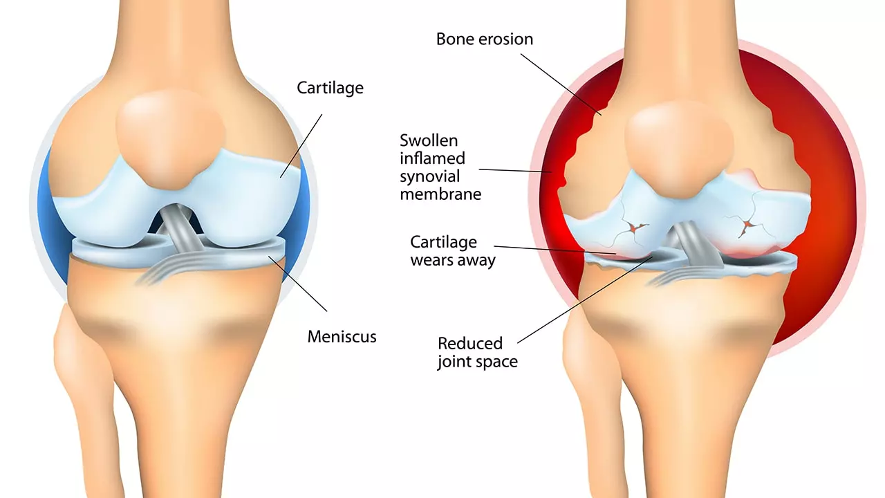 How to Prevent Joint Damage in Children and Adolescents